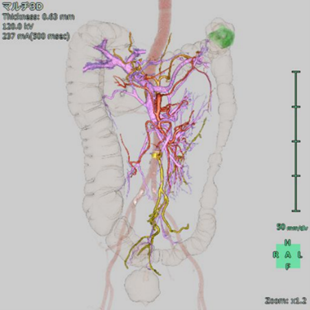 大腸腫瘍術前画像