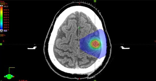 脳の定位放射線治療