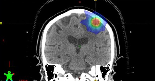 脳の定位放射線治療