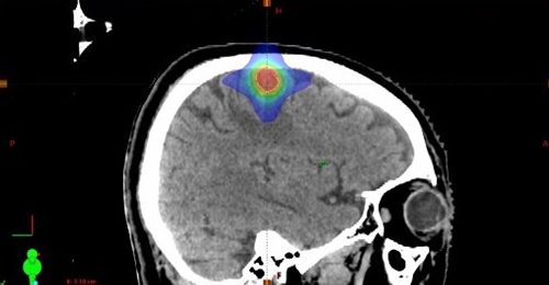 脳の定位放射線治療