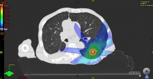 肺の定位放射線治療