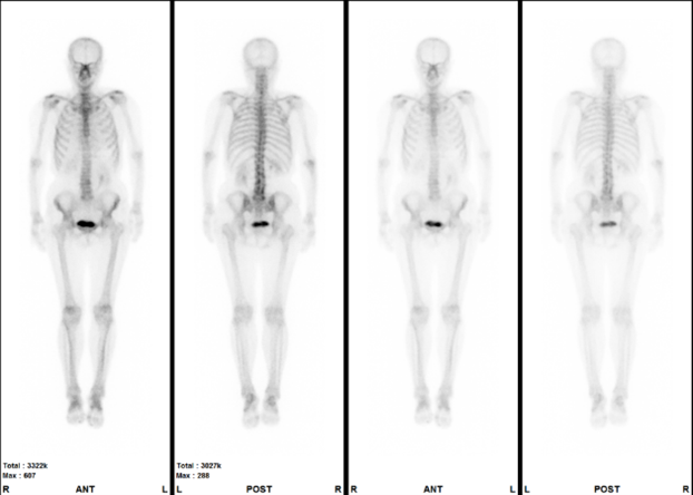 骨シンチグラフィ